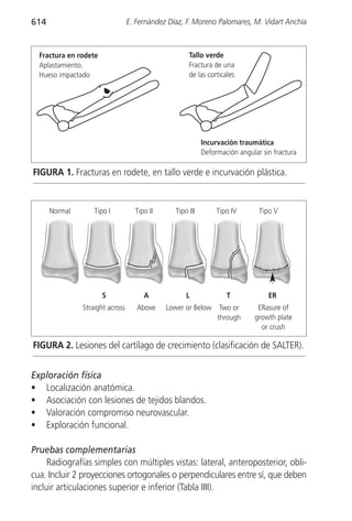 614                              E. Fernández Díaz, F. Moreno Palomares, M. Vidart Anchía



  Fractura en rodete                                 Tallo verde
  Aplastamiento.                                     Fractura de una
  Hueso impactado                                    de las corticales




                                                           Incurvación traumática
                                                           Deformación angular sin fractura

FIGURA 1. Fracturas en rodete, en tallo verde e incurvación plástica.


      Normal       Tipo I          Tipo II      Tipo III        Tipo IV       Tipo V




                       S              A             L              T             ER
               Straight across      Above    Lower or Below      Two or       ERasure of
                                                                through      growth plate
                                                                               or crush

FIGURA 2. Lesiones del cartílago de crecimiento (clasificación de SALTER).


Exploración física
• Localización anatómica.
• Asociación con lesiones de tejidos blandos.
• Valoración compromiso neurovascular.
• Exploración funcional.

Pruebas complementarias
     Radiografías simples con múltiples vistas: lateral, anteroposterior, obli-
cua. Incluir 2 proyecciones ortogonales o perpendiculares entre sí, que deben
incluir articulaciones superior e inferior (Tabla IIII).
 