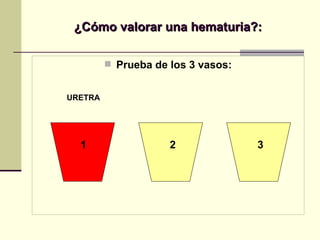 ¿Cómo valorar una hematuria?: Prueba de los 3 vasos: URETRA 1 2 3 