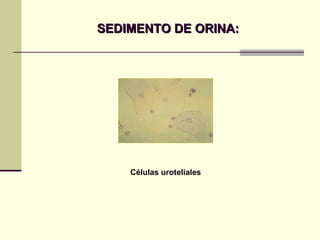 SEDIMENTO DE ORINA: Células uroteliales 