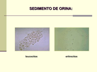 SEDIMENTO DE ORINA: leucocitos eritrocitos 