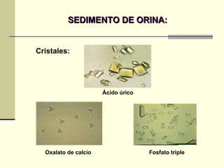SEDIMENTO DE ORINA: Ácido úrico Fosfato triple Cristales: Ácido úrico Oxalato de calcio 
