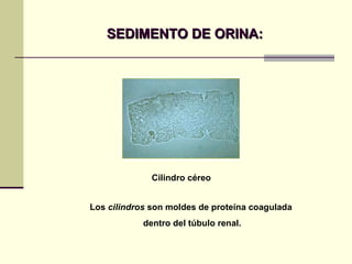 SEDIMENTO DE ORINA: Cilindro céreo Los  cilindros  son moldes de proteína coagulada  dentro del túbulo renal. 