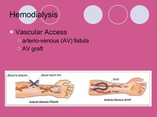 Hemodialysis Vascular Access arterio-venous (AV) fistula AV graft  