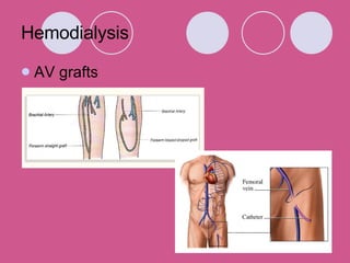 Hemodialysis AV grafts 