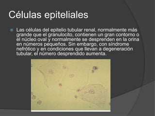 Células epiteliales
 Las células del epitelio tubular renal, normalmente más
grande que el granulocito, contienen un gran contorno o
el núcleo oval y normalmente se desprenden en la orina
en números pequeños. Sin embargo, con síndrome
nefrótico y en condiciones que llevan a degeneración
tubular, el número desprendido aumenta.
 