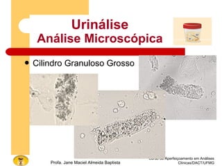Curso de Aperfeiçoamento em Análises
Clínicas/DACT/UFMGProfa. Jane Maciel Almeida Baptista
 Cilindro Granuloso Grosso
Urinálise
Análise Microscópica
 