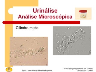 Curso de Aperfeiçoamento em Análises
Clínicas/DACT/UFMGProfa. Jane Maciel Almeida Baptista
Urinálise
Análise Microscópica
Cilindro misto
 