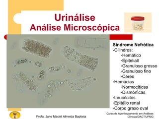 Curso de Aperfeiçoamento em Análises
Clínicas/DACT/UFMGProfa. Jane Maciel Almeida Baptista
Urinálise
Análise Microscópica
Síndrome Nefrótica
-Cilindros:
-Hemático
-Epiteliall
-Granuloso grosso
-Granuloso fino
-Céreo
-Hemácias
-Normocíticas
-Dismórficas
-Leucócitos
-Epitélio renal
-Corpo graxo oval
 