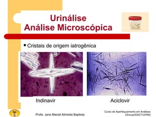 Urinálise
Análise Microscópica
Curso de Aperfeiçoamento em Análises
Clínicas/DACT/UFMGProfa. Jane Maciel Almeida Baptista
Cristais de origem iatrogênica
Indinavir Aciclovir
 