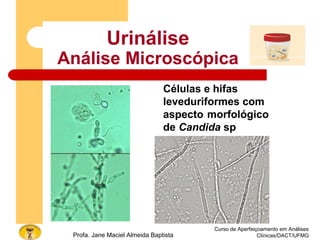 Curso de Aperfeiçoamento em Análises
Clínicas/DACT/UFMGProfa. Jane Maciel Almeida Baptista
Urinálise
Análise Microscópica
Células e hifas
leveduriformes com
aspecto morfológico
de Candida sp
 