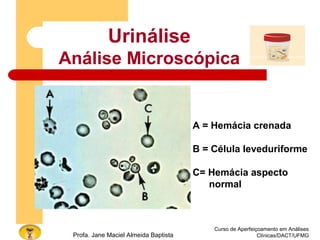 Curso de Aperfeiçoamento em Análises
Clínicas/DACT/UFMGProfa. Jane Maciel Almeida Baptista
A = Hemácia crenada
B = Célula leveduriforme
C= Hemácia aspecto
normal
Urinálise
Análise Microscópica
 