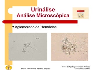 Curso de Aperfeiçoamento em Análises
Clínicas/DACT/UFMGProfa. Jane Maciel Almeida Baptista
Urinálise
Análise Microscópica
Aglomerado de Hemácias
 