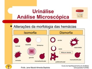 Urinálise
Análise Microscópica
 Alterações da morfologia das hemácias
Curso de Aperfeiçoamento em Análises
Clínicas/DACT/UFMGProfa. Jane Maciel Almeida Baptista
Isomorfia Dismorfia
normal
septada fantasma
crenada
grande
monodiverticular
anular
vazia
espiculada
Mistura destas
monodiverticular
polidiverticular
 