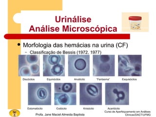 Urinálise
Análise Microscópica
 Morfologia das hemácias na urina (CF)
– Classificação de Bessis (1972, 1977)
Curso de Aperfeiçoamento em Análises
Clínicas/DACT/UFMGProfa. Jane Maciel Almeida Baptista
Discócitos Equinócitos Anulócito “Fantasma” Esquisócitos
Estomatócito Codócito Knisócito Acantócito
 