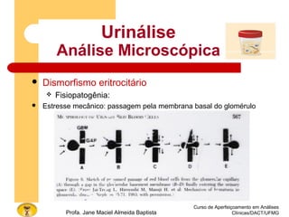 Curso de Aperfeiçoamento em Análises
Clínicas/DACT/UFMGProfa. Jane Maciel Almeida Baptista
Urinálise
Análise Microscópica
 Dismorfismo eritrocitário
 Fisiopatogênia:
 Estresse mecânico: passagem pela membrana basal do glomérulo
 