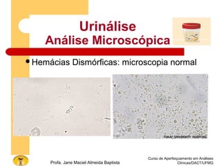 Curso de Aperfeiçoamento em Análises
Clínicas/DACT/UFMGProfa. Jane Maciel Almeida Baptista
Urinálise
Análise Microscópica
Hemácias Dismórficas: microscopia normal
 