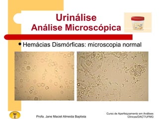 Curso de Aperfeiçoamento em Análises
Clínicas/DACT/UFMGProfa. Jane Maciel Almeida Baptista
Urinálise
Análise Microscópica
Hemácias Dismórficas: microscopia normal
 