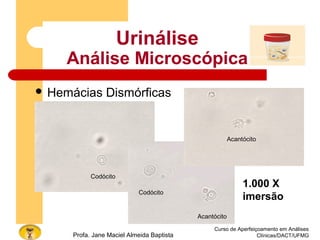 Curso de Aperfeiçoamento em Análises
Clínicas/DACT/UFMGProfa. Jane Maciel Almeida Baptista
Urinálise
Análise Microscópica
 Hemácias Dismórficas
Codócito
Codócito
Acantócito
Acantócito
1.000 X
imersão
 