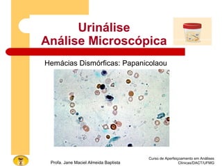 Urinálise
Análise Microscópica
Curso de Aperfeiçoamento em Análises
Clínicas/DACT/UFMGProfa. Jane Maciel Almeida Baptista
Hemácias Dismórficas: Papanicolaou
 