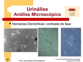 Curso de Aperfeiçoamento em Análises
Clínicas/DACT/UFMGProfa. Jane Maciel Almeida Baptista
Urinálise
Análise Microscópica
 Hemácias Dismórficas: contraste de fase
 