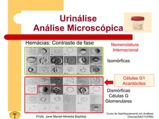 Urinálise
Análise Microscópica
Hemácias: Contraste de fase
Curso de Aperfeiçoamento em Análises
Clínicas/DACT/UFMGProfa. Jane Maciel Almeida Baptista
Nomenclatura
Internacional
Isomórficas
Células G1
Acantócitos
Dismórficas
Células G
Glomerulares
 