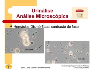 Urinálise
Análise Microscópica
 Hemácias Dismórficas: contraste de fase
Curso de Aperfeiçoamento em Análises
Clínicas/DACT/UFMGProfa. Jane Maciel Almeida Baptista
 
