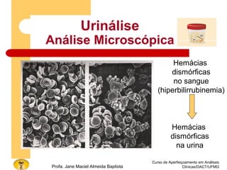 Curso de Aperfeiçoamento em Análises
Clínicas/DACT/UFMGProfa. Jane Maciel Almeida Baptista
Urinálise
Análise Microscópica
Hemácias
dismórficas
no sangue
(hiperbilirrubinemia)
Hemácias
dismórficas
na urina
 