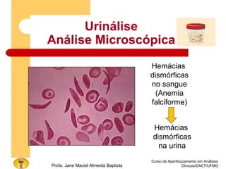 Urinálise
Análise Microscópica
Curso de Aperfeiçoamento em Análises
Clínicas/DACT/UFMGProfa. Jane Maciel Almeida Baptista
Hemácias
dismórficas
no sangue
(Anemia
falciforme)
Hemácias
dismórficas
na urina
 