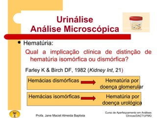 Urinálise
Análise Microscópica
Curso de Aperfeiçoamento em Análises
Clínicas/DACT/UFMGProfa. Jane Maciel Almeida Baptista
 Hematúria:
Qual a implicação clínica de distinção de
hematúria isomórfica ou dismórfica?
Farley K & Birch DF, 1982 (Kidney Int, 21)
Hemácias dismórficas Hematúria por
doença glomerular
Hemácias isomórficas Hematúria por
doença urológica
 