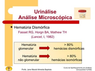 Urinálise
Análise Microscópica
 Hematúria Dismórfica
Fasset RG, Horgn BA, Mathew TH
(Lancet, I, 1982)
Curso de Aperfeiçoamento em Análises
Clínicas/DACT/UFMGProfa. Jane Maciel Almeida Baptista
Hematúria > 80%
glomerular hemácias dismórficas
Hematúria > 80%
não glomerular hemácias isomórficas
 
