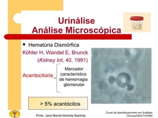 Urinálise
Análise Microscópica
 Hematúria Dismórfica
Köhler H, Wandel E, Brunck B
(Kidney Int, 40, 1991)
Acantocitúria
Curso de Aperfeiçoamento em Análises
Clínicas/DACT/UFMGProfa. Jane Maciel Almeida Baptista
Marcador
característico
de hemorragia
glomerular
> 5% acantócitos
 