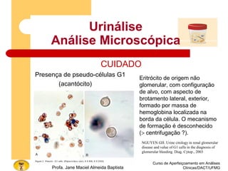 Urinálise
Análise Microscópica
CUIDADO
Presença de pseudo-células G1
(acantócito)
Curso de Aperfeiçoamento em Análises
Clínicas/DACT/UFMGProfa. Jane Maciel Almeida Baptista
Eritrócito de origem não
glomerular, com configuração
de alvo, com aspecto de
brotamento lateral, exterior,
formado por massa de
hemoglobina localizada na
borda da célula. O mecanismo
de formação é desconhecido
(> centrifugação ?).
NGUYEN GH. Urine citology in renal glomerular
disease and value of G1 cells in the diagnosis of
glomerular bleeding. Diag. Cytop., 2003
 