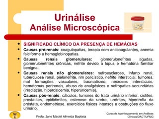 Curso de Aperfeiçoamento em Análises
Clínicas/DACT/UFMGProfa. Jane Maciel Almeida Baptista
Urinálise
Análise Microscópica
 SIGNIFICADO CLÍNICO DA PRESENÇA DE HEMÁCIAS
 Causas pré-renais: coagulopatias, terapia com anticoagulantes, anemia
falciforme e hemoglobinopatias.
 Causas renais glomerulares: glomerulonefrites agudas,
glomerulonefrites crônicas, nefrite devido a lúpus e hematúria familiar
benigna.
 Causas renais não glomerulares: nefroesclerose, infarto renal,
tuberculose renal, pielonefrite, rim policístico, nefrite intersticial, tumores,
mal formações vasculares, traumatismo, necroses intersticiais,
hematomas perirenais, abuso de analgésicos e nefropatias secundárias
(irradiação, hipercalcemia, hiperuricemia).
 Causas pós-renais: cálculos, tumores do trato urinário inferior, cistites,
prostatites, epididimites, estenose da uretra, uretrites, hipertrofia da
próstata, endometriose, exercícios físicos intensos e obstruções do fluxo
urinário.
 