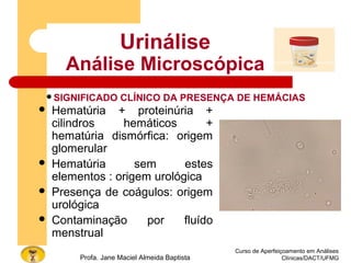 Curso de Aperfeiçoamento em Análises
Clínicas/DACT/UFMGProfa. Jane Maciel Almeida Baptista
Urinálise
Análise Microscópica
 Hematúria + proteinúria +
cilindros hemáticos +
hematúria dismórfica: origem
glomerular
 Hematúria sem estes
elementos : origem urológica
 Presença de coágulos: origem
urológica
 Contaminação por fluído
menstrual
SIGNIFICADO CLÍNICO DA PRESENÇA DE HEMÁCIAS
 