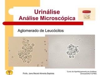 Curso de Aperfeiçoamento em Análises
Clínicas/DACT/UFMGProfa. Jane Maciel Almeida Baptista
Urinálise
Análise Microscópica
Aglomerado de Leucócitos
 