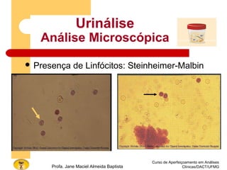Curso de Aperfeiçoamento em Análises
Clínicas/DACT/UFMGProfa. Jane Maciel Almeida Baptista
Urinálise
Análise Microscópica
 Presença de Linfócitos: Steinheimer-Malbin
 