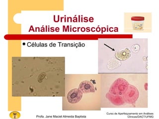 Curso de Aperfeiçoamento em Análises
Clínicas/DACT/UFMGProfa. Jane Maciel Almeida Baptista
Urinálise
Análise Microscópica
Células de Transição
 