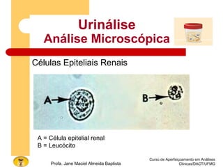 Curso de Aperfeiçoamento em Análises
Clínicas/DACT/UFMGProfa. Jane Maciel Almeida Baptista
Urinálise
Análise Microscópica
Células Epiteliais Renais
A = Célula epitelial renal
B = Leucócito
 