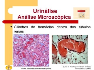 Curso de Aperfeiçoamento em Análises
Clínicas/DACT/UFMGProfa. Jane Maciel Almeida Baptista
Urinálise
Análise Microscópica
 Cilindros de hemácias dentro dos túbulos
renais
 