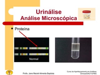 Curso de Aperfeiçoamento em Análises
Clínicas/DACT/UFMGProfa. Jane Maciel Almeida Baptista
Urinálise
Análise Microscópica
 Proteína
Normal
 