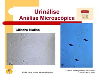 Curso de Aperfeiçoamento em Análises
Clínicas/DACT/UFMGProfa. Jane Maciel Almeida Baptista
Urinálise
Análise Microscópica
Cilindro Hialino
 