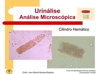 Curso de Aperfeiçoamento em Análises
Clínicas/DACT/UFMGProfa. Jane Maciel Almeida Baptista
Urinálise
Análise Microscópica
Cilindro Hemático
 