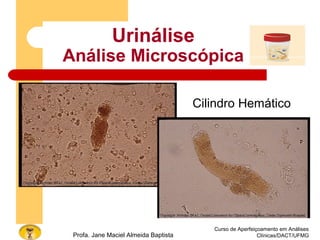 Curso de Aperfeiçoamento em Análises
Clínicas/DACT/UFMGProfa. Jane Maciel Almeida Baptista
Urinálise
Análise Microscópica
Cilindro Hemático
 