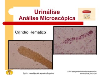 Curso de Aperfeiçoamento em Análises
Clínicas/DACT/UFMGProfa. Jane Maciel Almeida Baptista
Urinálise
Análise Microscópica
Cilindro Hemático
 