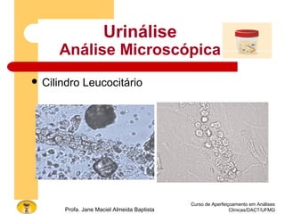 Curso de Aperfeiçoamento em Análises
Clínicas/DACT/UFMGProfa. Jane Maciel Almeida Baptista
 Cilindro Leucocitário
Urinálise
Análise Microscópica
 