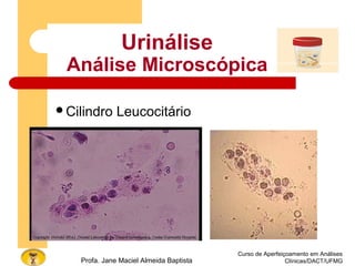 Curso de Aperfeiçoamento em Análises
Clínicas/DACT/UFMGProfa. Jane Maciel Almeida Baptista
Urinálise
Análise Microscópica
Cilindro Leucocitário
 