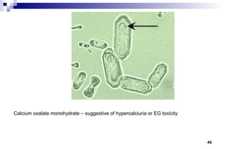 Calcium oxalate monohydrate – suggestive of hypercalciuria or EG toxicity




                                                                            42
 