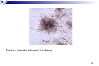 Tyrosine – associated with severe liver disease




                                                  46
 