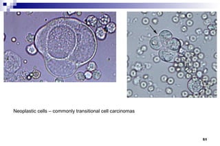 Neoplastic cells – commonly transitional cell carcinomas




                                                           51
 