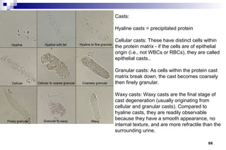 Casts:

Hyaline casts = precipitated protein

Cellular casts: These have distinct cells within
the protein matrix - if the cells are of epithelial
origin (i.e., not WBCs or RBCs), they are called
epithelial casts..

Granular casts: As cells within the protein cast
matrix break down, the cast becomes coarsely
then finely granular.

Waxy casts: Waxy casts are the final stage of
cast degeneration (usually originating from
cellular and granular casts). Compared to
hyaline casts, they are readily observable
because they have a smooth appearance, no
internal texture, and are more refractile than the
surrounding urine.

                                             55
 